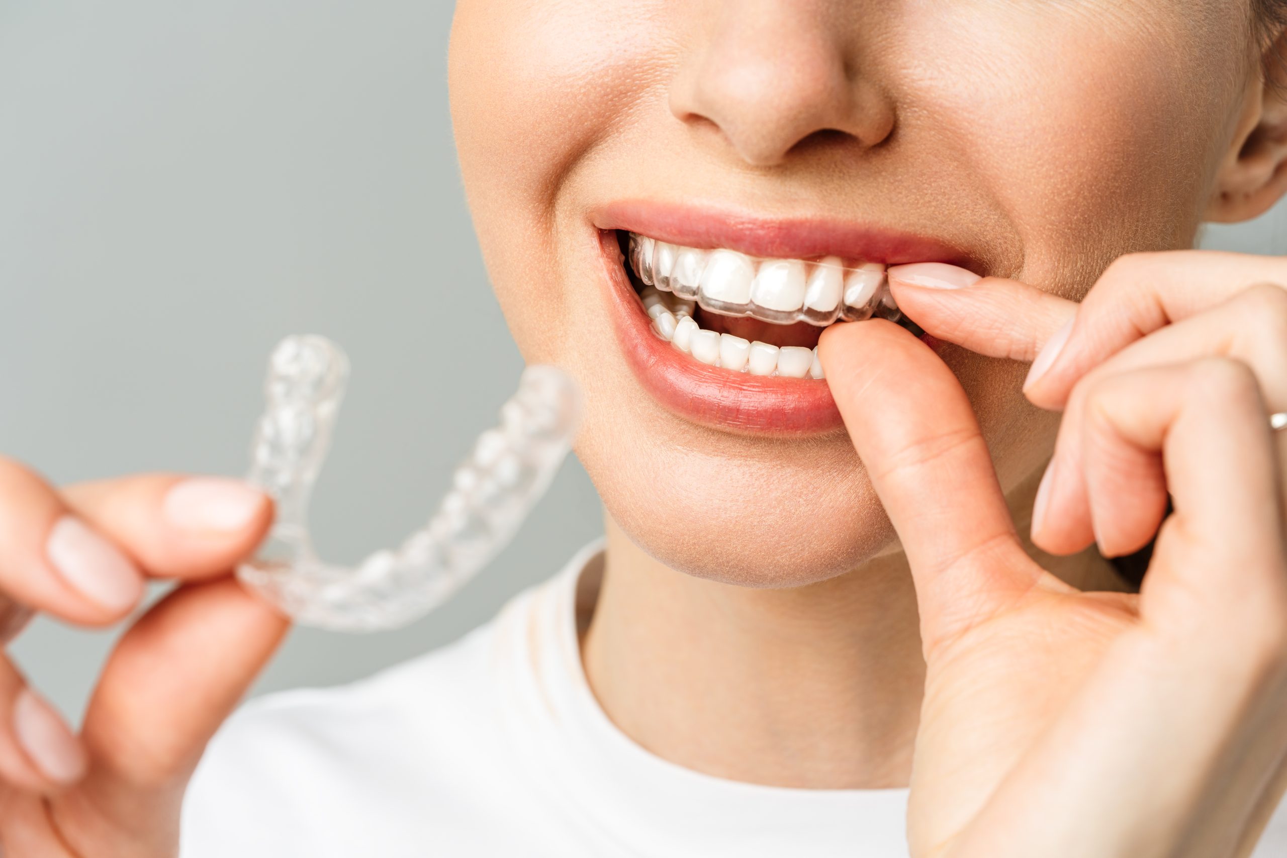 Unlocking the Magic of Invisalign for All Age Groups